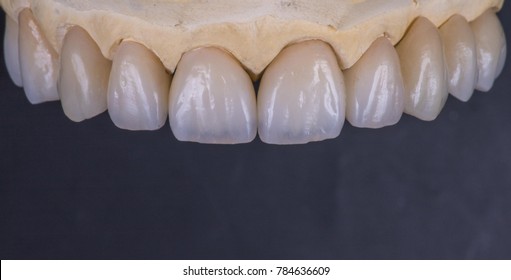 Dental Ceramic Crowns