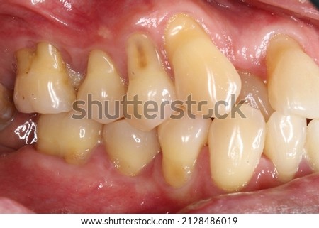 Dental cervical abrasion with gingival recession due to hard brushing