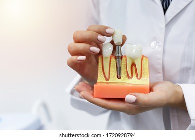 dental concept. the hands of a dentist doctor hold a model of teeth with a dental implant 