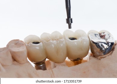 Dental crown and bridge for implant supported prostheses using small screw. Screw retained bridge on implant with dental teeth model, stone model.