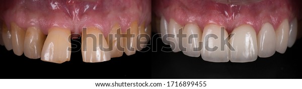 Descubra Corona Dental Y Barniz Antes Y Imagenes De Stock En Hd Y Millones De Otras Fotos Ilustraciones Y Vectores En Stock Libres De Regalias En La Coleccion De Shutterstock Se Agregan Miles De Imagenes Nuevas De Alta Calidad Todos Los Dias