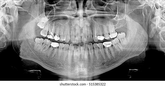 Dental crowns, Original black and white x-ray teeth scan