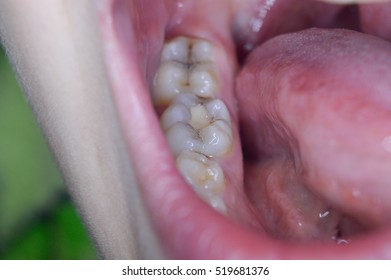 Dental Filling