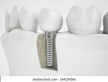 Dental implant - Shutterstock ID 164139365