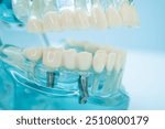 Dental implant, artificial tooth roots into jaw, root canal of dental treatment, gum disease, teeth model for dentist studying about dentistry.