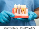 Dental implant, artificial tooth roots into jaw, root canal of dental treatment, gum disease, teeth model for dentist studying about dentistry.