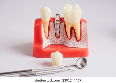 Dental implant, artificial tooth roots into jaw, root canal of dental treatment, gum disease, teeth model for dentist studying about dentistry.