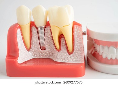 Dental implant, artificial tooth roots into jaw, root canal of dental treatment, gum disease, teeth model for dentist studying about dentistry.