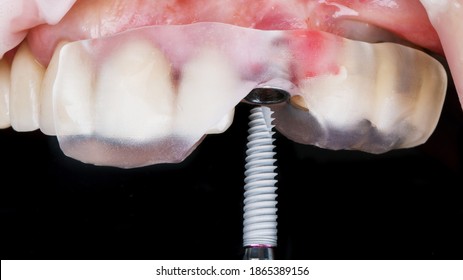 Dental Implant Before Insertion Through A Surgical Template For Accuracy