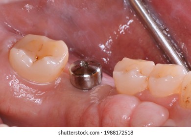 Dental implant healing abutment six point five diameter - Shutterstock ID 1988172518