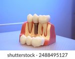 dental implant, model, plate, denture. Dental implant, artificial tooth roots into jaw, root canal of dental treatment, gum disease, teeth model for dentist studying about dentistry.