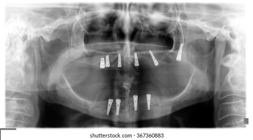 Dental Implant And Teeth. X-ray View