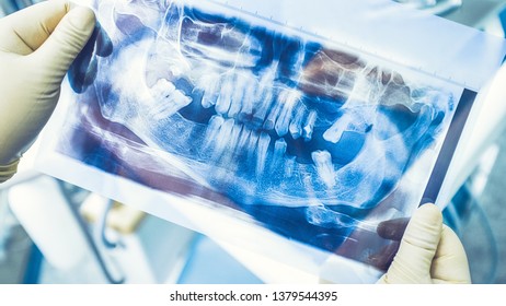 Dental Implant Therapy. Diagnostic Before Replacement Of Damaged And Missing Teeth. Surgeon Studying Panoramic X Ray.