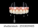 Dental implant treatment applied to edentulous jaws in dental dentistry. Full arch dental prostheses supported by implants, known as All on Four and All on X treatments. Implant prostheses and screws 