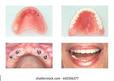 Dental Implants  And Denture  Of Upper Jaw 