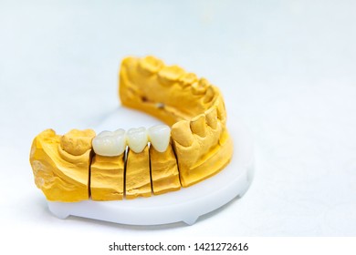 Dental Implants. Restore Lost Teeth. Dental Bridge On The Jaw Mockup. Dental Laboratory.