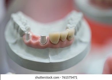 Dental Implants Training Models Stock Photo 761575471 | Shutterstock