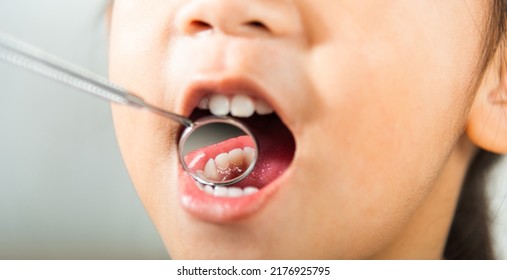 Dental Kid Health Examination. Doctor Examines Oral Cavity Of Little Child Uses Mouth Mirror To Checking Teeth Cavity, Asian Dentist Making Examination Procedure For Smiling Cute Little Girl