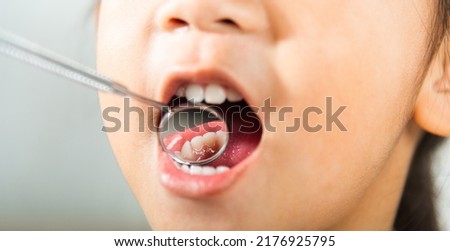 Dental kid health examination. Doctor examines oral cavity of little child uses mouth mirror to checking teeth cavity, Asian dentist making examination procedure for smiling cute little girl