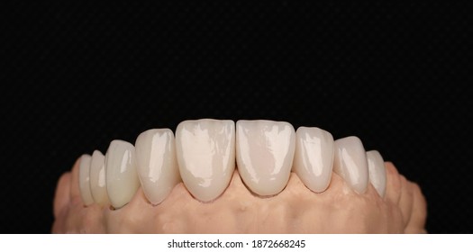dental laminate veneers, zirconia ceramic crowns
3d printed dental model