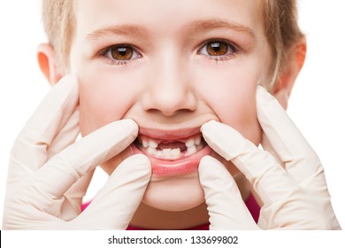 Dental Medicine And Healthcare - Child Patient Open Mouth Showing First Baby Milk Or Temporary Teeth Fall Out