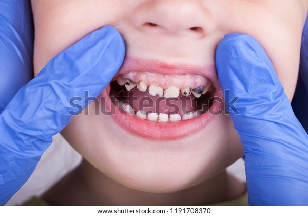歯科医療 虫歯を見せる女の子患者の口を開いた口を調べる歯科医師 の写真素材 今すぐ編集