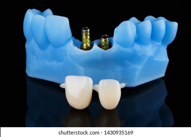 Dental Model Of 3D Printer And Standard Gold Abutments With Crowns For Installation On Abutments