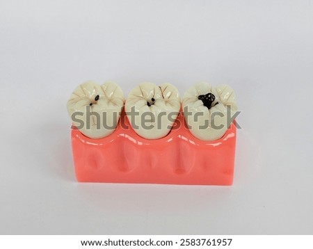 Dental model showcasing three teeth with varying levels of decay using a vivid display for educational purposes