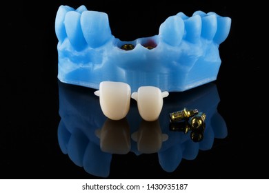 Dental Model And Standard Gold Abutments With Crowns For Mounting On Black Glass Abutments With Reflection