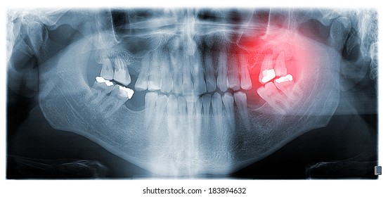 Dental panoramic x-ray showing granuloma marked red at upper second and third molar on the left. First signs of periodontitis.