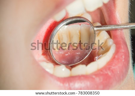 dental plaque on the lower front teeth close up