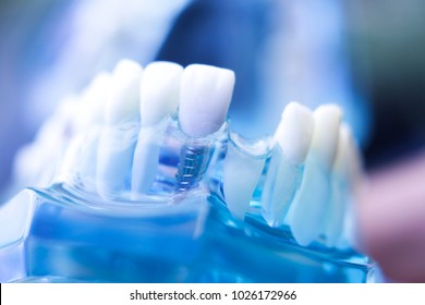 Dental Prosthetic Teeth, Gums, Roots Teaching Student Model With Gap In Front Teeth.