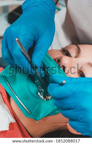 Dental restoration and polymerization of tooth composite materials, the doctor conducts sterile work on tooth restoration.