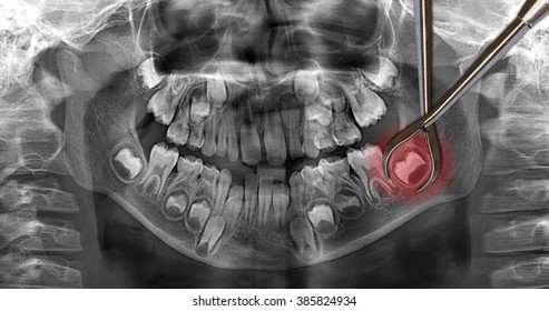 Dental Scan: Wisdom Teeth