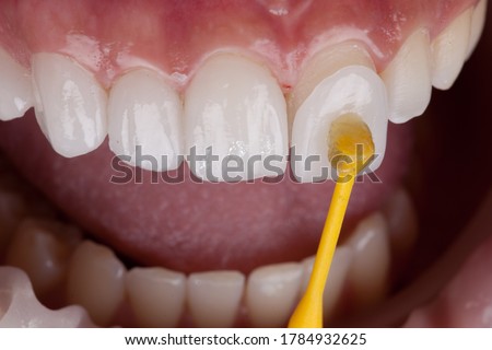 Dental, Smile design, White teeth