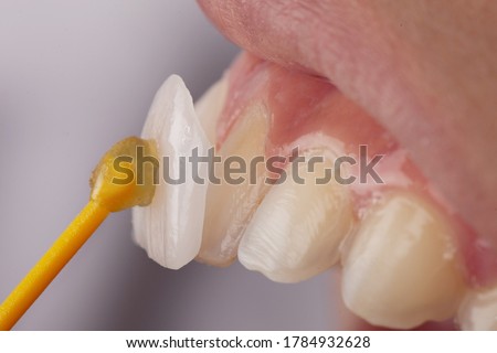 Dental, Smile design, White teeth