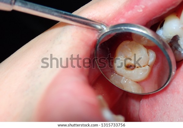 A dental tooth decay\
cavity found during routine dental examination check up using a\
dental mirror