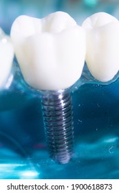 Dental Tooth Metal Implant Dentistry Teaching Model Showing Teeth And Gum.