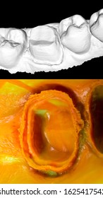 Dental Traditional Impression By Silicon Vs  Digital Impressuon By Oral Scanner