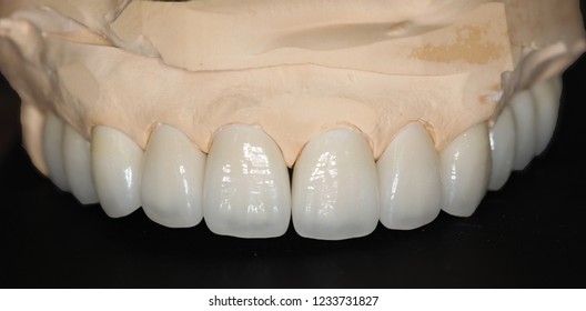 Dental Treatment With Total Porcelain Crowns And Veneers 