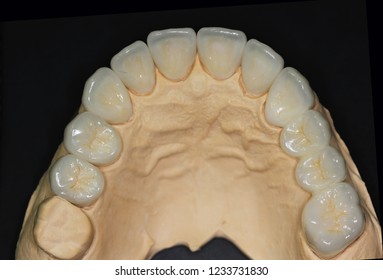 Dental treatment with total porcelain crowns and veneers 