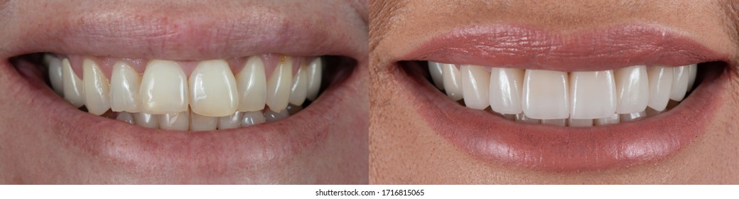 Dental veneer before and after smile. Smile makeover with dental ceramic veneers treatment, result in clean, well aligned,perfect, youth and white teeth smile. 