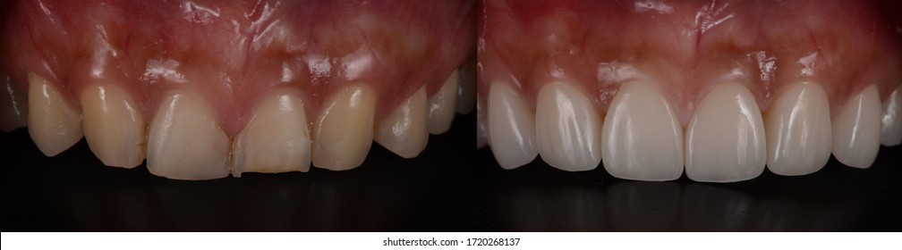 Dental Veneer Before And After. Smile Makeover With Dental Ceramic Veneers Treatment, Result In Rejuvenate, White Teeth Smile. 