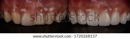 Dental veneer before and after. Smile makeover with dental ceramic veneers treatment, result in rejuvenate, white teeth smile. 