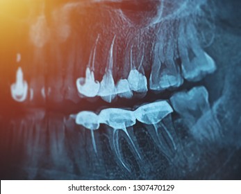 Dental Xray For All Teeth, Side View