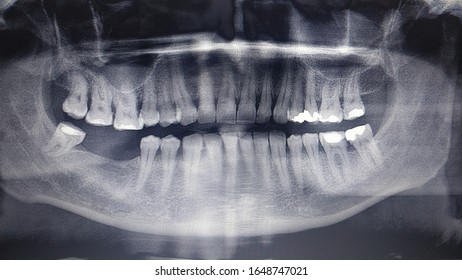 Dental X-rays with missing teeth.