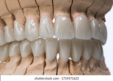 Dental zircon ceramic crowns on model / two jaw