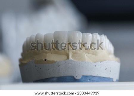Dental zirconium crowns on a lab model.