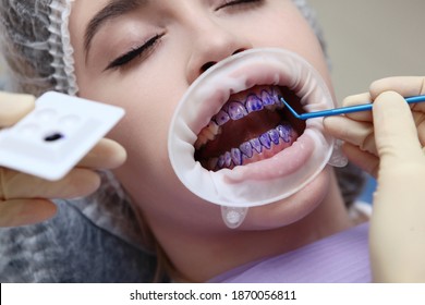 The dentist applies the tooth of a purple gel on the patient's teeth prior to a professional dental cleaning. Prevention of caries and gum diseases. Hands in protective gloves. Macro photo. Top view. - Shutterstock ID 1870056811