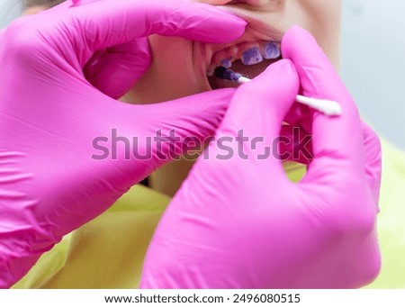Dentist applying plaque disclosing solution to child's teeth. High quality photo